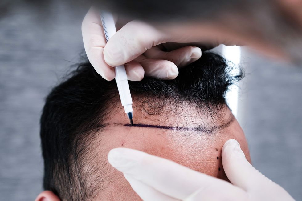 Doctor drawing on a man's head before surgery.