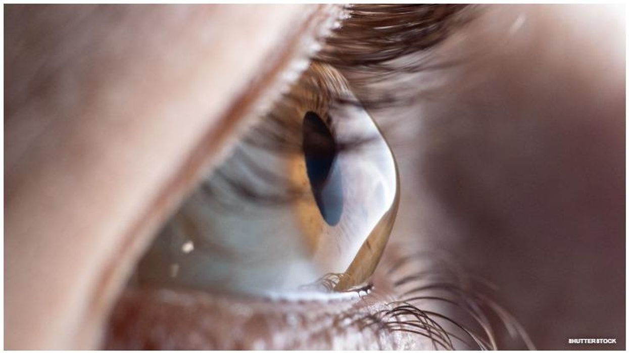 Federal policies prevent eye donations from men who have sex with men in the previous five years, resulting in a shortage of eye donors according to a new study.