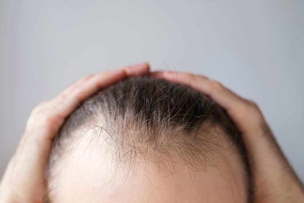 Someone with hair loss holding their head