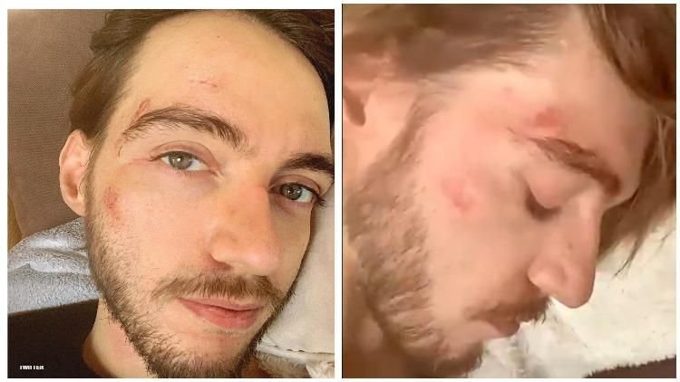 Gay Man Attacked in Hate Crime Fears Reporting Assault to Police