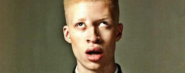 Shaun albino model nose